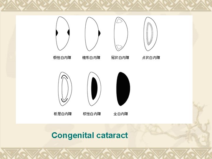 Congenital cataract Congenital cataract