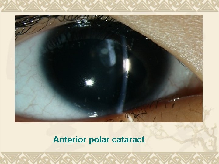 Anterior polar cataract Anterior polar cataract