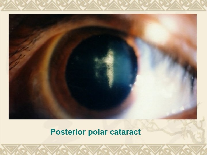 Posterior polar cataract Posterior polar cataract