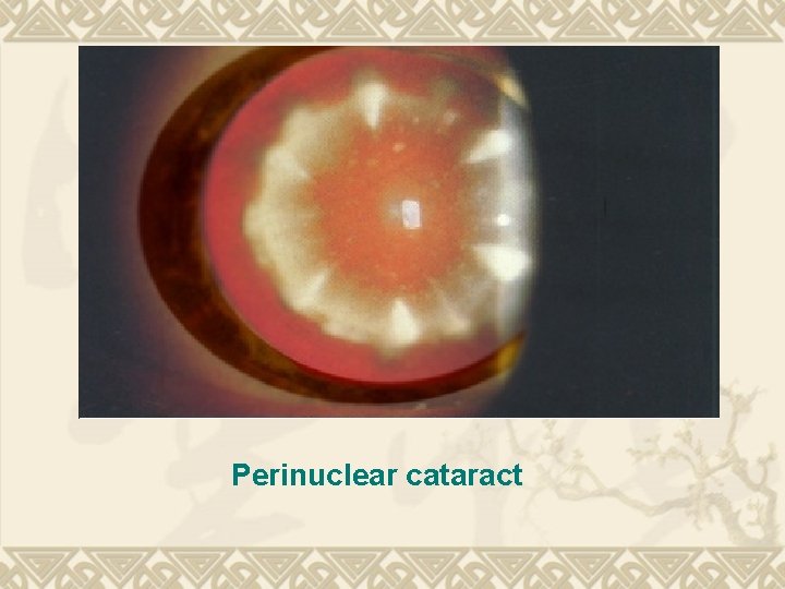 Perinuclear cataract Perinuclear cataract