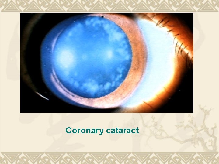 Coronary cataract Coronary cataract