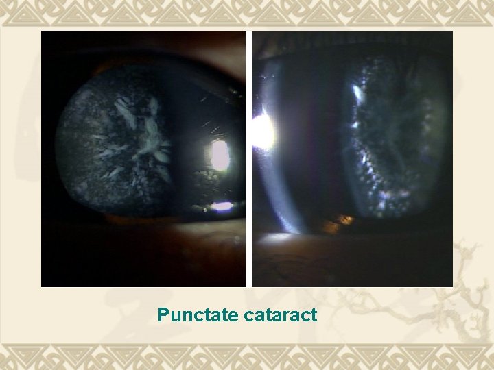 Punctate cataract Punctate cataract