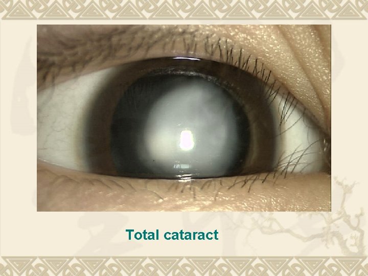 Total cataract Total cataract