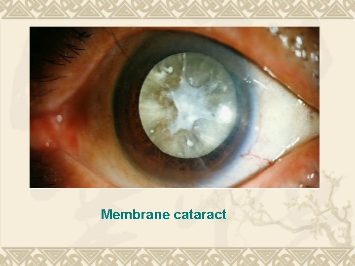 Membrane cataract Membrane cataract