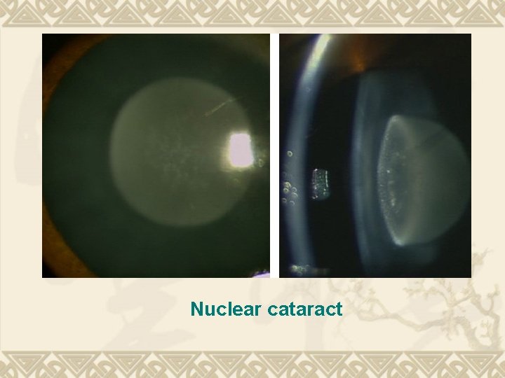 Nuclear cataract Nuclear cataract