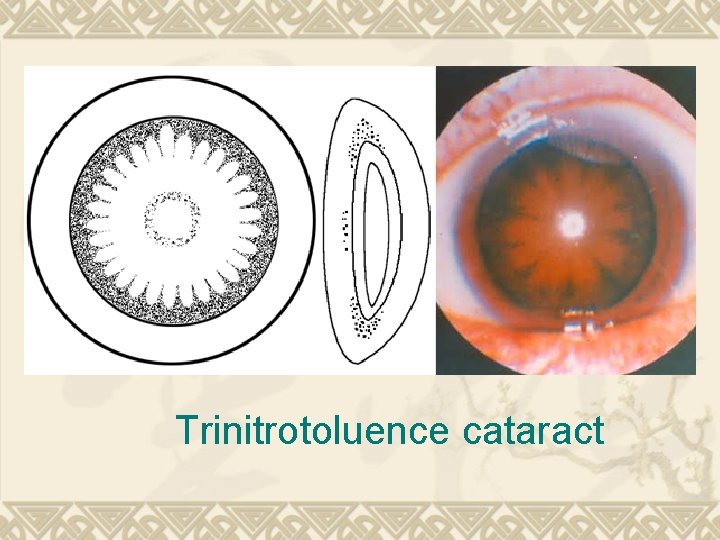 Trinitrotoluence cataract Trinitrotoluence cataract