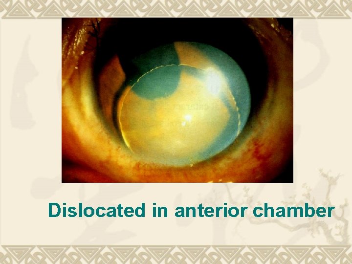 Dislocated in anterior chamber Dislocated in anterior chamber