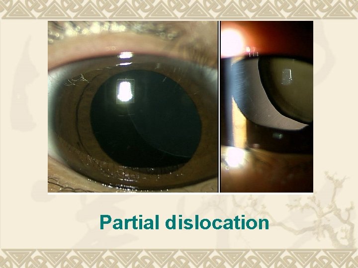 Partial dislocation Partial dislocation