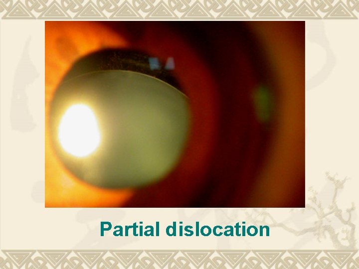 Partial dislocation Partial dislocation