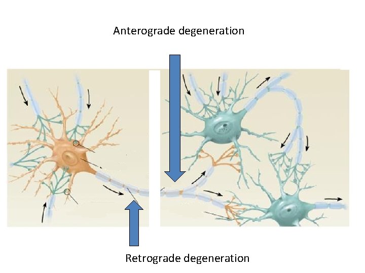 Anterograde degeneration Retrograde degeneration 