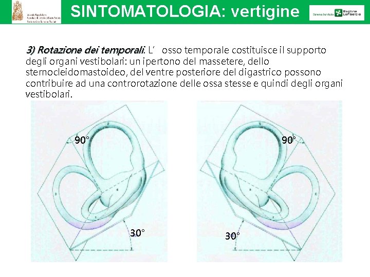 SINTOMATOLOGIA: vertigine 3) Rotazione dei temporali. L’osso temporale costituisce il supporto degli organi vestibolari: