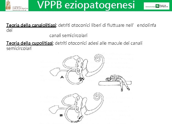 VPPB eziopatogenesi Teoria della canalolitiasi: detriti otoconici liberi di fluttuare nell’endolinfa dei canali semicircolari