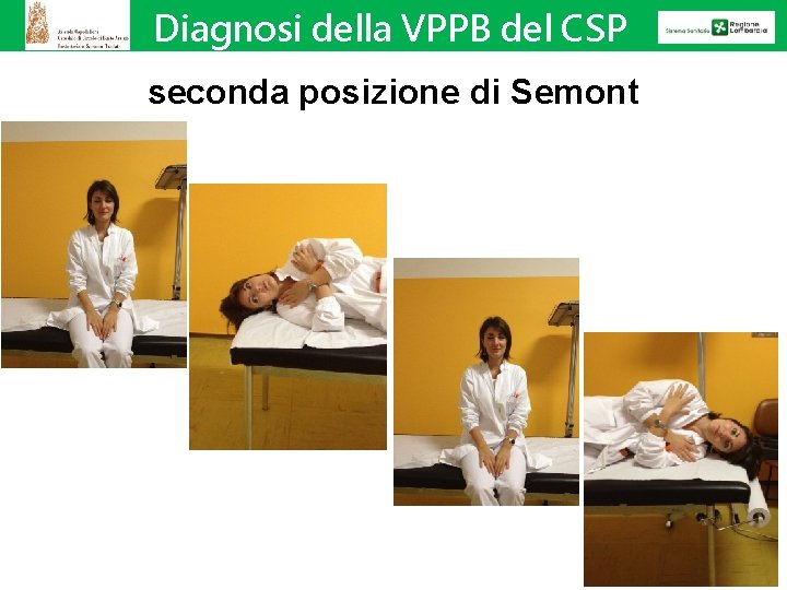 Diagnosi della VPPB del CSP seconda posizione di Semont 