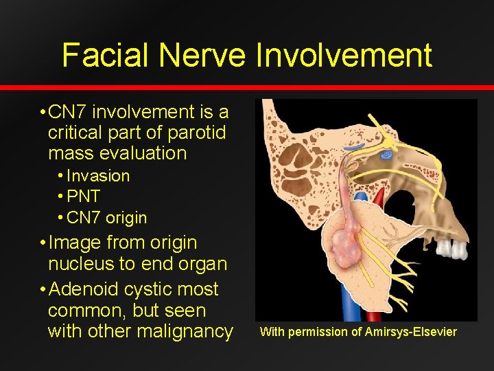 Facial Nerve Involvement • CN 7 involvement is a critical part of parotid mass