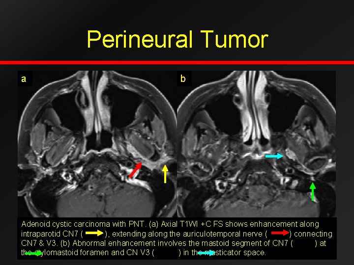 Perineural Tumor a b Adenoid cystic carcinoma with PNT. (a) Axial T 1 WI