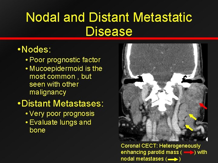 Nodal and Distant Metastatic Disease • Nodes: • Poor prognostic factor • Mucoepidermoid is