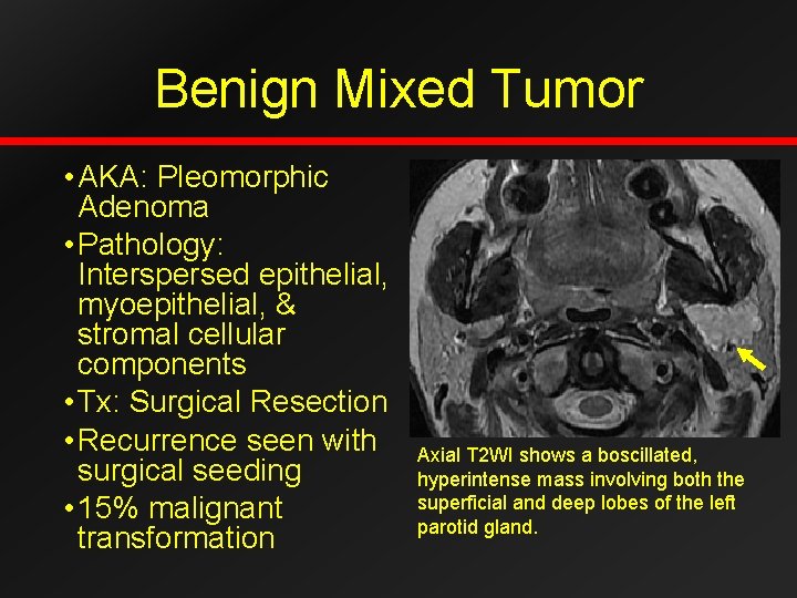 Benign Mixed Tumor • AKA: Pleomorphic Adenoma • Pathology: Interspersed epithelial, myoepithelial, & stromal