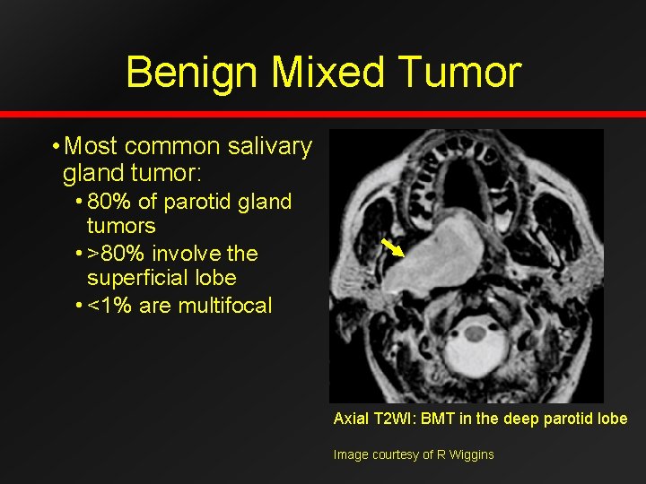 Benign Mixed Tumor • Most common salivary gland tumor: • 80% of parotid gland