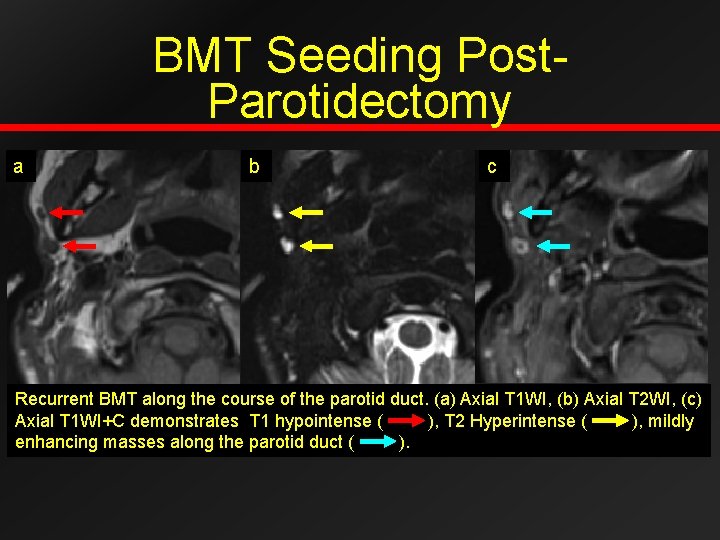 BMT Seeding Post. Parotidectomy a b c Recurrent BMT along the course of the