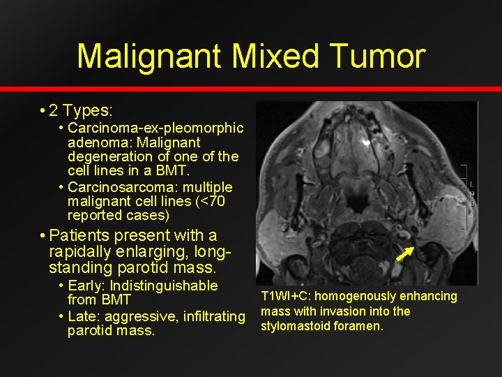 Malignant Mixed Tumor • 2 Types: • Carcinoma-ex-pleomorphic adenoma: Malignant degeneration of one of