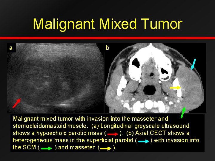 Malignant Mixed Tumor a b Malignant mixed tumor with invasion into the masseter and