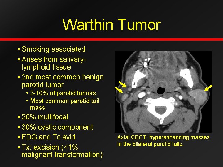 Warthin Tumor • Smoking associated • Arises from salivarylymphoid tissue • 2 nd most