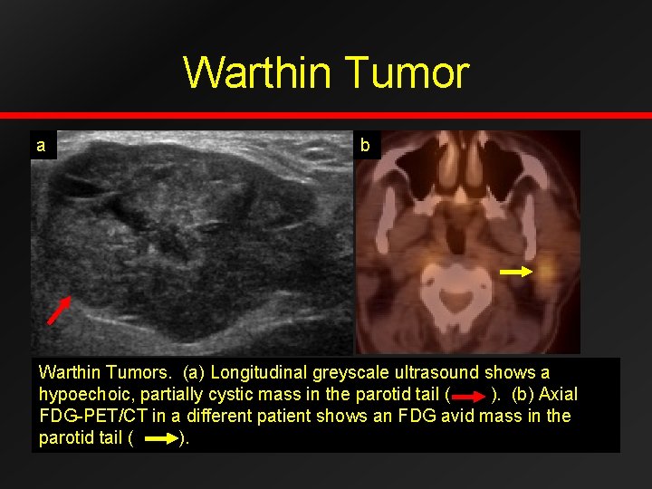 Warthin Tumor a b Warthin Tumors. (a) Longitudinal greyscale ultrasound shows a hypoechoic, partially