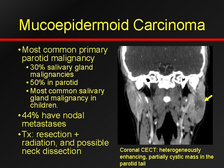 Mucoepidermoid Carcinoma • Most common primary parotid malignancy • 30% salivary gland malignancies •