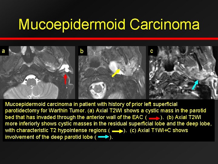 Mucoepidermoid Carcinoma a b c Mucoepidermoid carcinoma in patient with history of prior left