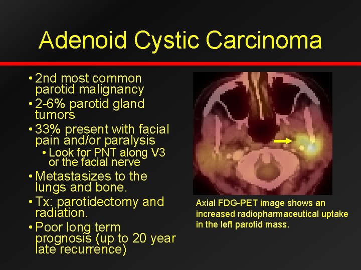 Adenoid Cystic Carcinoma • 2 nd most common parotid malignancy • 2 -6% parotid
