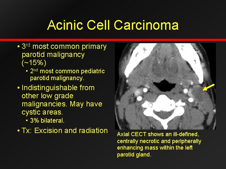 Acinic Cell Carcinoma • 3 rd most common primary parotid malignancy (~15%) • 2