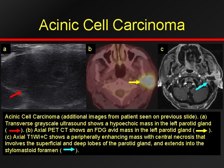 Acinic Cell Carcinoma a b c Acinic Cell Carcinoma (additional images from patient seen