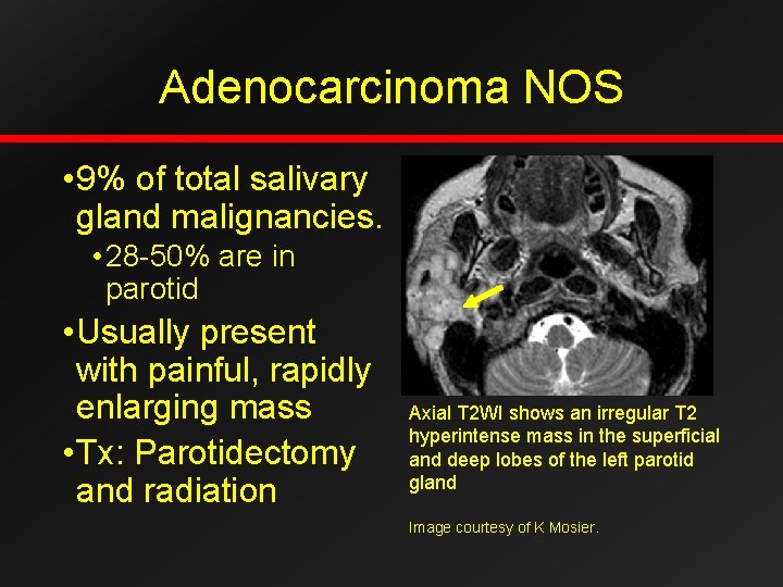 Adenocarcinoma NOS • 9% of total salivary gland malignancies. • 28 -50% are in