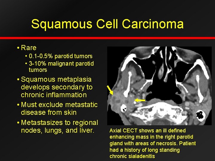 Squamous Cell Carcinoma • Rare • 0. 1 -0. 5% parotid tumors • 3