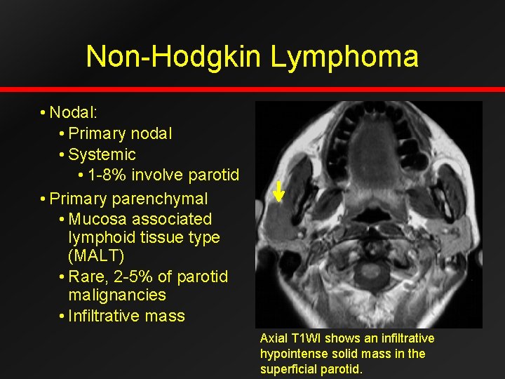 Non-Hodgkin Lymphoma • Nodal: • Primary nodal • Systemic • 1 -8% involve parotid