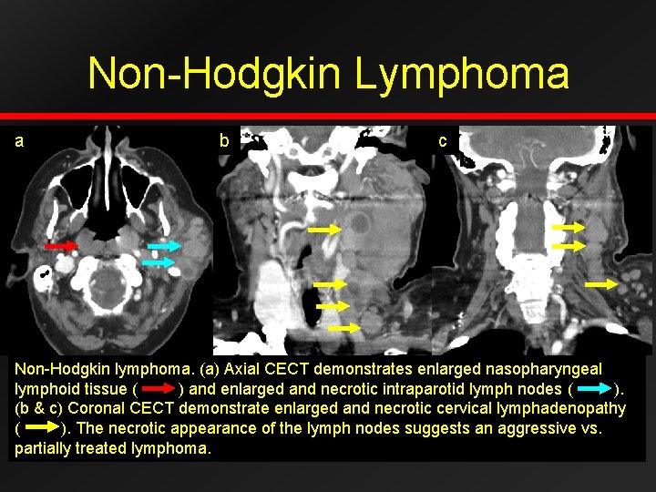 Non-Hodgkin Lymphoma a b c Non-Hodgkin lymphoma. (a) Axial CECT demonstrates enlarged nasopharyngeal lymphoid