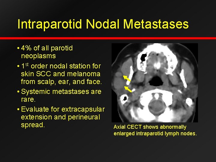 Intraparotid Nodal Metastases • 4% of all parotid neoplasms • 1 st order nodal