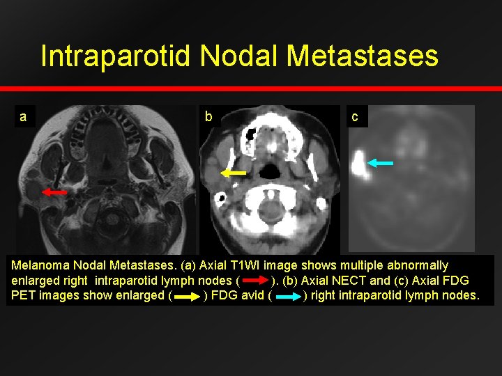 Intraparotid Nodal Metastases a b c Melanoma Nodal Metastases. (a) Axial T 1 WI