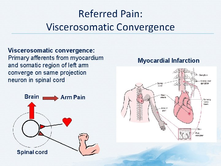 Referred Pain: Viscerosomatic Convergence Viscerosomatic convergence: Primary afferents from myocardium and somatic region of