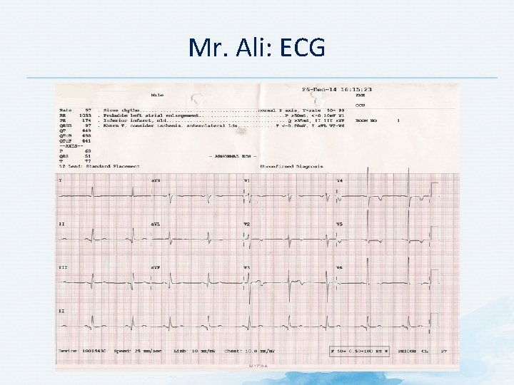 Mr. Ali: ECG 