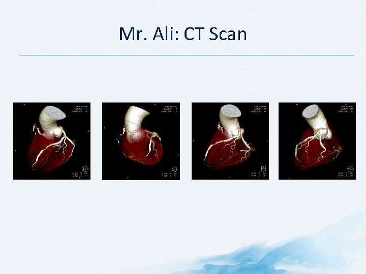 Mr. Ali: CT Scan 