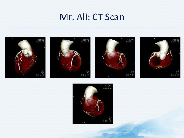 Mr. Ali: CT Scan 