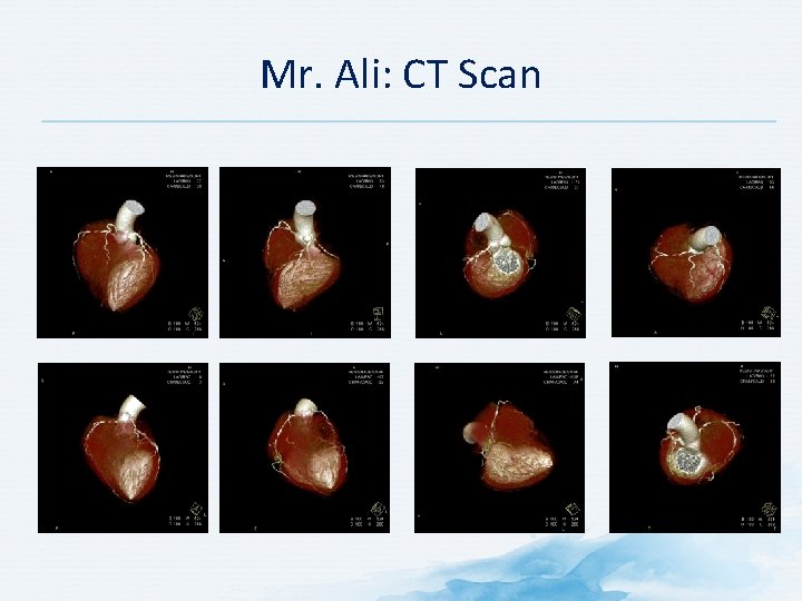 Mr. Ali: CT Scan 