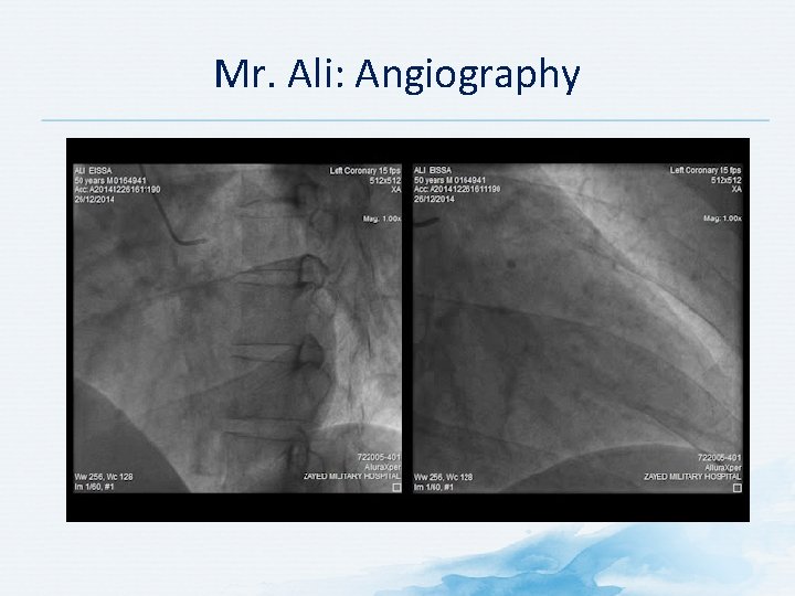 Mr. Ali: Angiography 