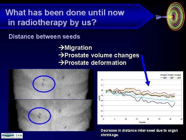 What has been done until now in radiotherapy by us? Distance between seeds Migration