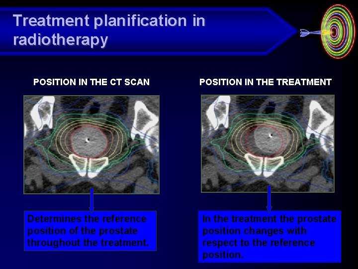 Treatment planification in radiotherapy POSITION IN THE CT SCAN Determines the reference position of