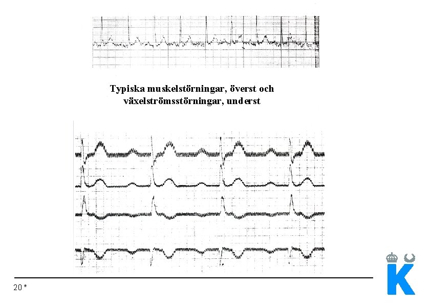 Typiska muskelstörningar, överst och växelströmsstörningar, underst 20 * 