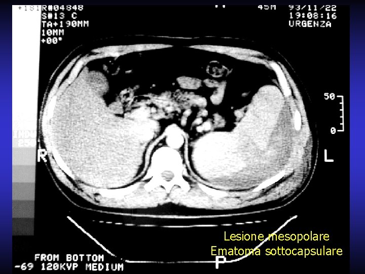 Lesione mesopolare Ematoma sottocapsulare 