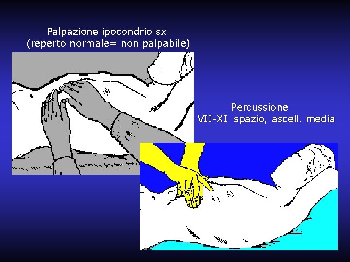 Palpazione ipocondrio sx (reperto normale= non palpabile) Percussione VII-XI spazio, ascell. media 