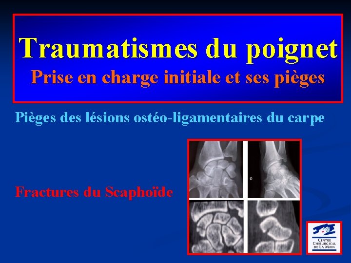 Traumatismes du poignet Prise en charge initiale et ses pièges Pièges des lésions ostéo-ligamentaires